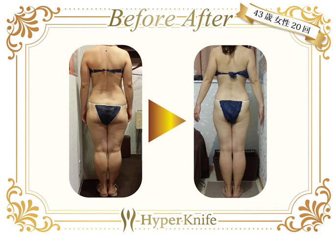 ハイパーナイフ | 広島市南区で口コミ上位 あさひ整骨院